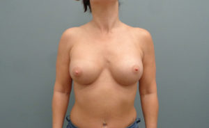 Breast Augmentation Before & After Pictures in Nashville, TN