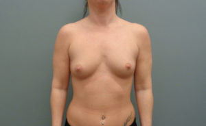 Breast Augmentation Before & After Pictures in Nashville, TN