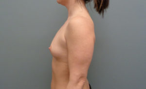 Breast Augmentation Before & After Pictures in Nashville, TN