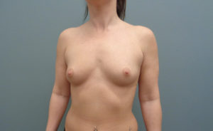 Breast Augmentation Before & After Pictures in Nashville, TN