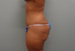 Tummy Tuck Before & After Pictures in Nashville, TN