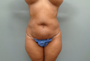 Tummy Tuck Before & After Pictures in Nashville, TN