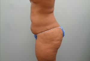 Tummy Tuck Before & After Pictures in Nashville, TN