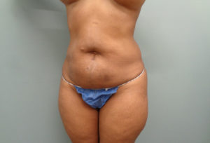 Tummy Tuck Before & After Pictures in Nashville, TN