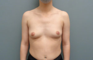 Breast Augmentation Before & After Pictures in Nashville, TN