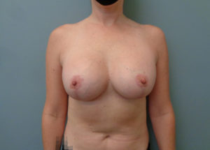 Breast Augmentation with Lift Before & After Pictures in Nashville, TN