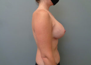 Breast Augmentation with Lift Before & After Pictures in Nashville, TN