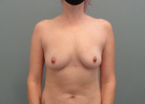 Breast Augmentation with Lift Before & After Pictures in Nashville, TN