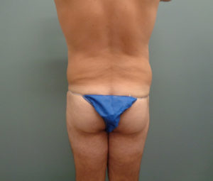 Body Lift Before & After Pictures in Nashville, TN