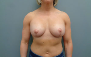 Breast Augmentation with Lift Before & After Pictures in Nashville, TN