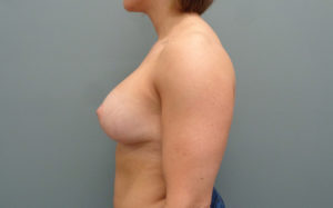 Breast Augmentation with Lift Before & After Pictures in Nashville, TN