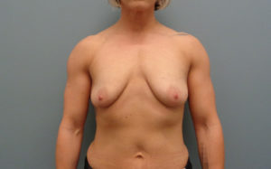 Breast Augmentation with Lift Before & After Pictures in Nashville, TN