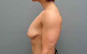 Breast Augmentation with Lift Before & After Pictures in Nashville, TN