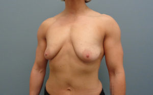 Breast Augmentation with Lift Before & After Pictures in Nashville, TN