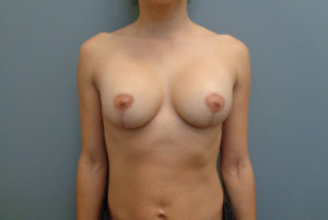 Breast Augmentation with Lift Before & After Pictures in Nashville, TN