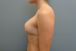 Breast Augmentation with Lift Before & After Pictures in Nashville, TN