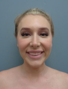 Otoplasty Before & After Pictures in Nashville, TN