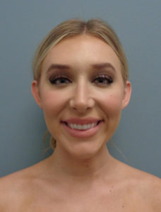 Otoplasty Before & After Pictures in Nashville, TN