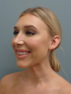 Otoplasty Before & After Pictures in Nashville, TN