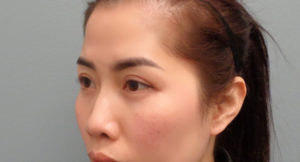 Blepharoplasty Before and After Pictures in Nashville, TN