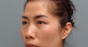 Blepharoplasty Before and After Pictures in Nashville, TN