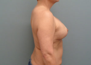 Breast Augmentation with Lift Before and After Pictures in Nashville, TN