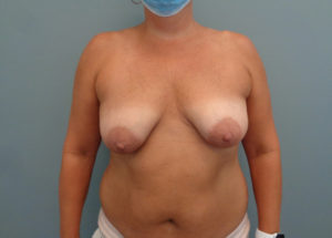 Breast Augmentation with Lift Before and After Pictures in Nashville, TN