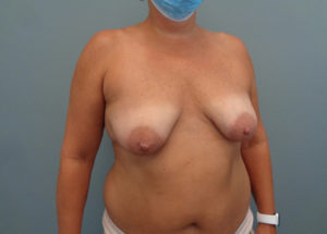 Breast Augmentation with Lift Before and After Pictures in Nashville, TN