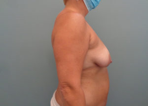 Breast Augmentation with Lift Before and After Pictures in Nashville, TN