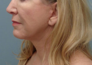 Neck lift Before and After Pictures in Nashville, TN