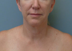 Neck lift Before and After Pictures in Nashville, TN