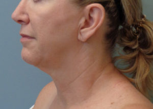 Neck lift Before and After Pictures in Nashville, TN