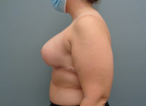 Plastic Surgery Before and After Pictures in Nashville, TN
