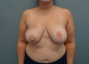Implant Exchange Before and After Pictures in Nashville, TN