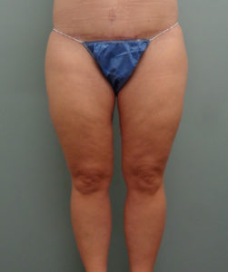 Thigh Lift Before and After Pictures in Nashville, TN