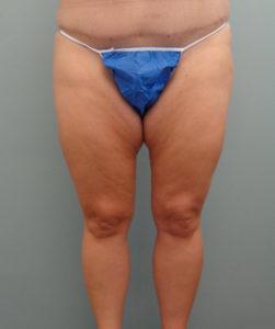 Thigh Lift Before and After Pictures in Nashville, TN