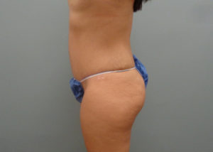 Tummy Tuck Before and After Pictures in Nashville, TN