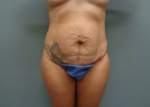 Tummy Tuck Before and After Pictures in Nashville, TN