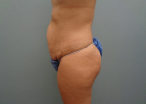 Tummy Tuck Before and After Pictures in Nashville, TN