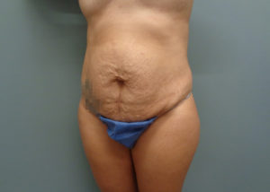 Tummy Tuck Before and After Pictures in Nashville, TN