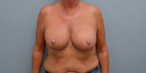 BREAST AUGMENTATION WITH LIFT BEFORE & AFTER PICTURES IN NASHVILLE, TN