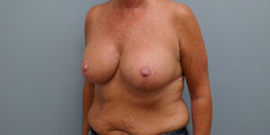 BREAST AUGMENTATION WITH LIFT BEFORE & AFTER PICTURES IN NASHVILLE, TN