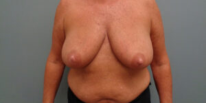 BREAST AUGMENTATION WITH LIFT BEFORE & AFTER PICTURES IN NASHVILLE, TN