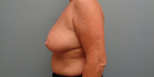 BREAST AUGMENTATION WITH LIFT BEFORE & AFTER PICTURES IN NASHVILLE, TN