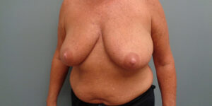 BREAST AUGMENTATION WITH LIFT BEFORE & AFTER PICTURES IN NASHVILLE, TN