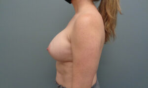 BREAST AUGMENTATION BEFORE & AFTER PICTURES IN NASHVILLE, TN