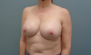 BREAST AUGMENTATION BEFORE & AFTER PICTURES IN NASHVILLE, TN