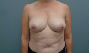 BREAST AUGMENTATION BEFORE & AFTER PICTURES IN NASHVILLE, TN