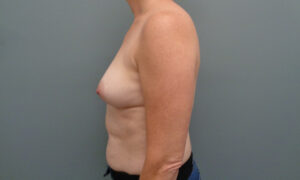 BREAST AUGMENTATION BEFORE & AFTER PICTURES IN NASHVILLE, TN