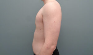 GYNECOMASTIA BEFORE & AFTER PICTURES IN NASHVILLE, TN